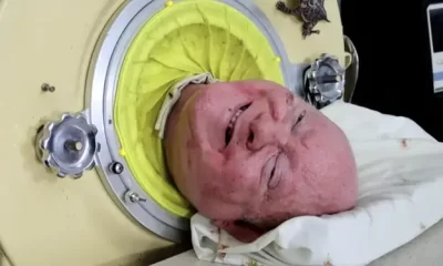 Man dies after living in iron lung for 70 years