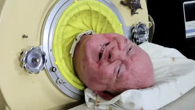 Man dies after living in iron lung for 70 years