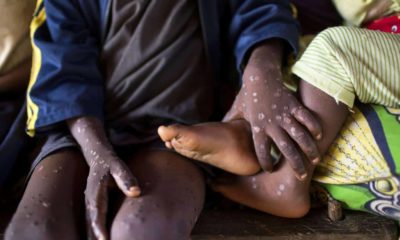 Africa CDC declares mpox public health emergency