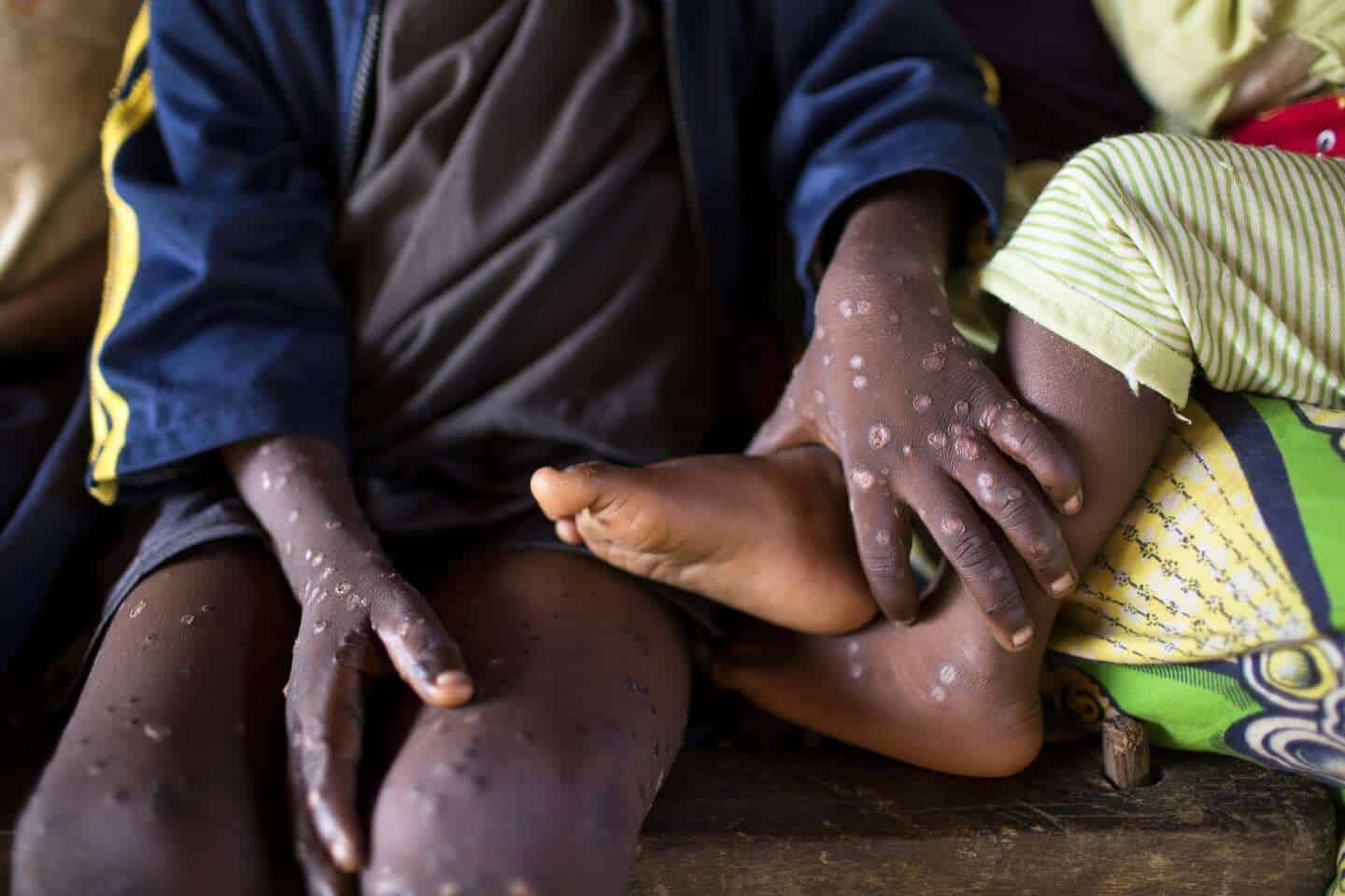 Africa CDC declares mpox public health emergency